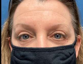 Blepharoplasty Before & After Patient #2308