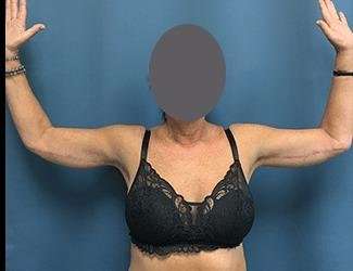 Arm Lift Before & After Patient #2461