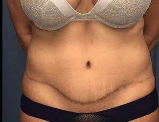 Tummy Tuck Before & After Patient #395