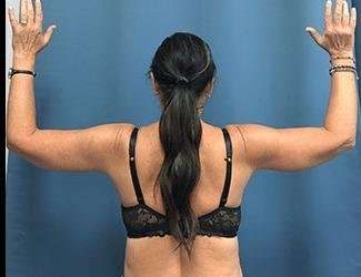 Arm Lift Before & After Patient #2461