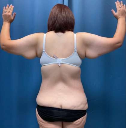 Tummy Tuck Before & After Patient #260