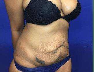 Tummy Tuck Before & After Patient #349