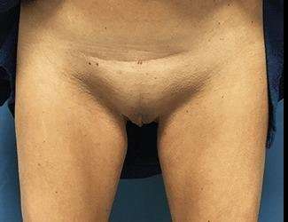 Labiaplasty Before & After Patient #1319