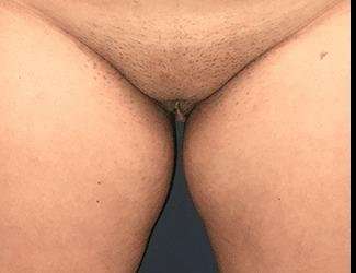 Labiaplasty Before & After Patient #1324