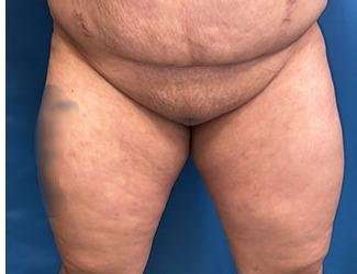 Labiaplasty Before & After Patient #1329