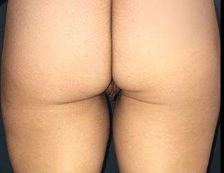 Labiaplasty Before & After Patient #1340