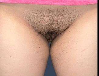 Labiaplasty Before & After Patient #2772