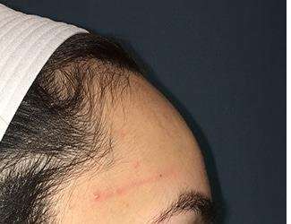 Forehead Reduction Before & After Patient #1364
