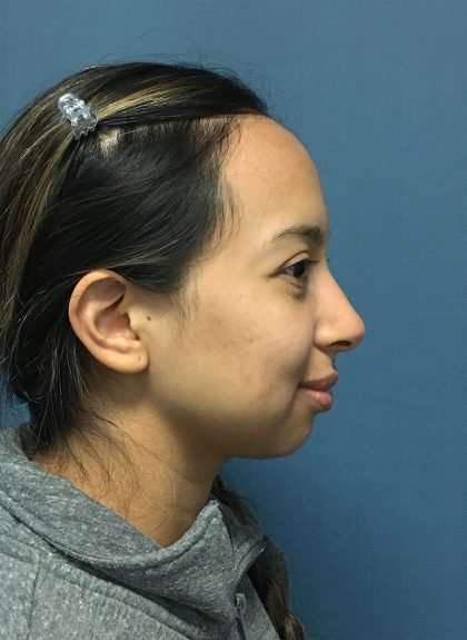 Forehead Reduction Before & After Patient #1371