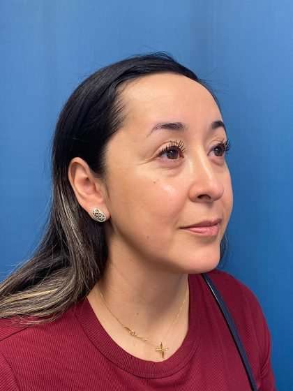Forehead Reduction Before & After Patient #1376