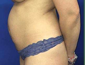 Tummy Tuck Before & After Patient #358
