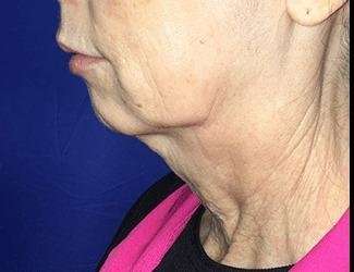 Facial Implants Before & After Patient #1392