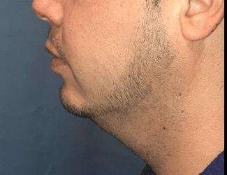Facial Implants Before & After Patient #1403