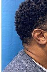 Facial Implants Before & After Patient #1440