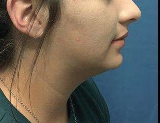 Facial Implants Before & After Patient #1453