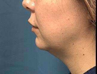Facial Implants Before & After Patient #1464