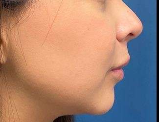 Facial Implants Before & After Patient #1475