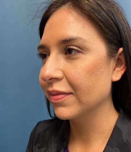 Facial Implants Before & After Patient #1486