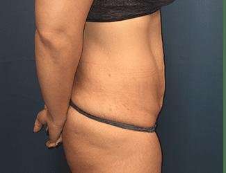 Tummy Tuck Before & After Patient #369