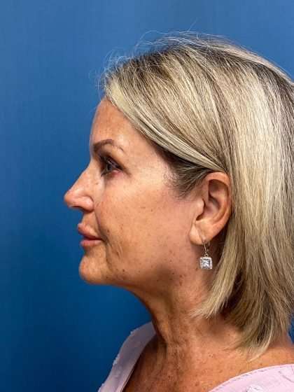 Facelift And Necklift Before & After Patient #1497