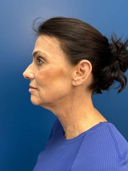 Facelift And Necklift Before & After Patient #1506