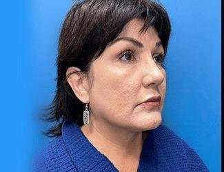 Facelift And Necklift Before & After Patient #1513