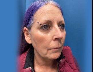 Facelift And Necklift Before & After Patient #1520