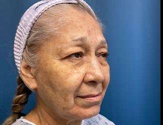 Facelift And Necklift Before & After Patient #1531