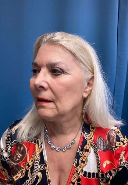 Facelift And Necklift Before & After Patient #1542