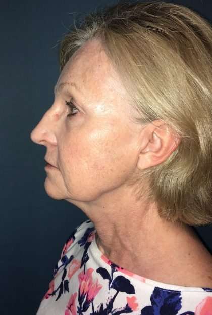 Facelift And Necklift Before & After Patient #1549