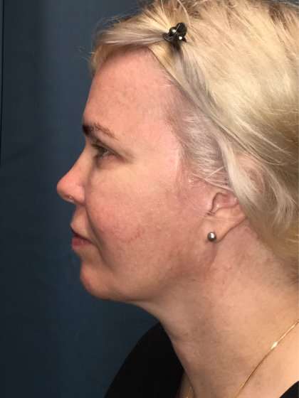 Facelift And Necklift Before & After Patient #1582