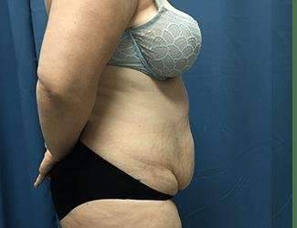 Tummy Tuck Before & After Patient #380