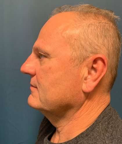 Facelift And Necklift Before & After Patient #1593
