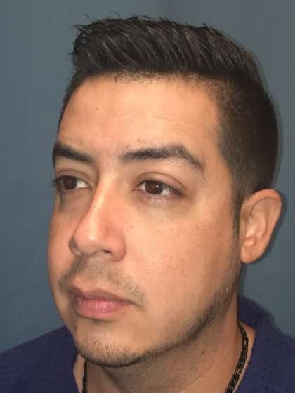 Chin Implant Before & After Patient #1604