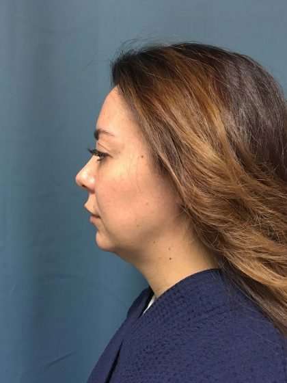 Chin Implant Before & After Patient #1611