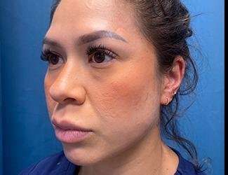 Buccal Fat Removal Before & After Patient #1643