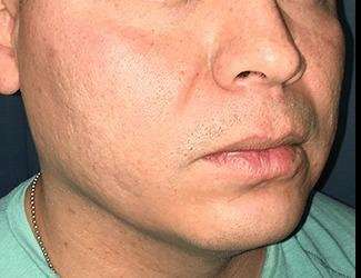 Buccal Fat Removal Before & After Patient #1656