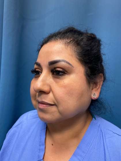 Buccal Fat Removal Before & After Patient #1663