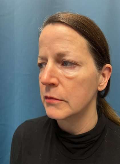 Brow Lift Before & After Patient #1674