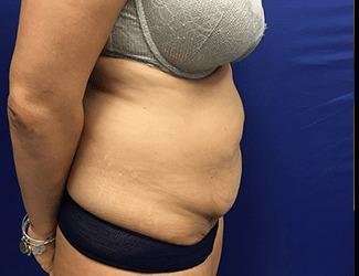 Tummy Tuck Before & After Patient #395