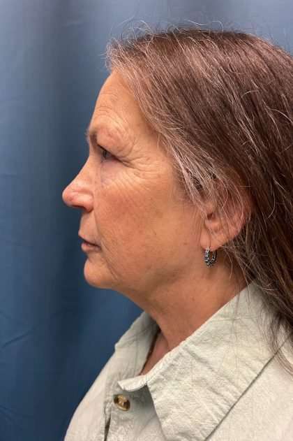 Brow Lift Before & After Patient #1685
