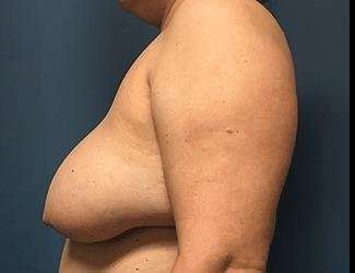 Breast Reduction Before & After Patient #1727
