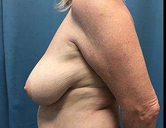 Breast Reduction Before & After Patient #1760