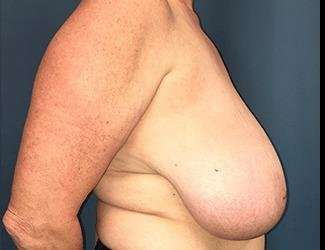 Breast Reduction Before & After Patient #1771