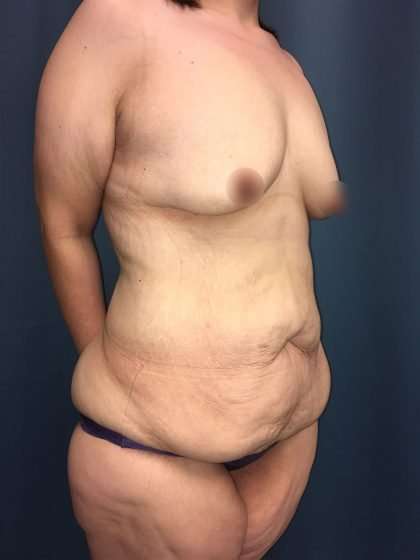 Tummy Tuck Before & After Patient #406