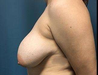Breast Reduction Before & After Patient #1793