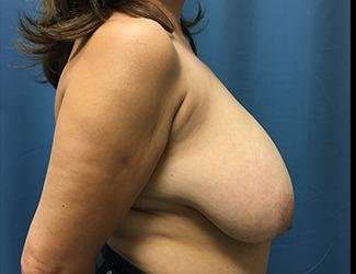 Breast Reduction Before & After Patient #1804
