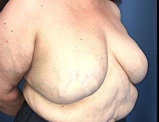 Breast Reduction Before & After Patient #1815