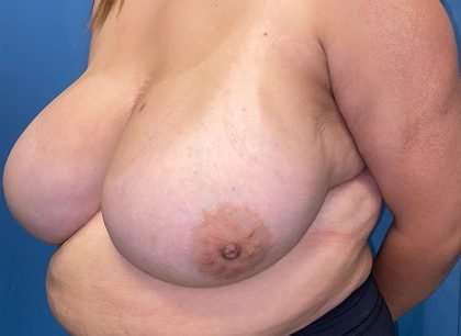 Breast Reduction Before & After Patient #1829