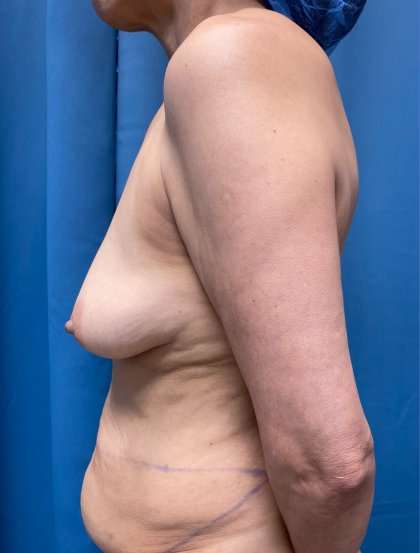 Breast Lift Before & After Patient #1861
